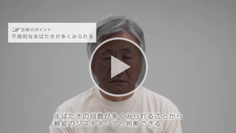 表情筋 軽症 症例3