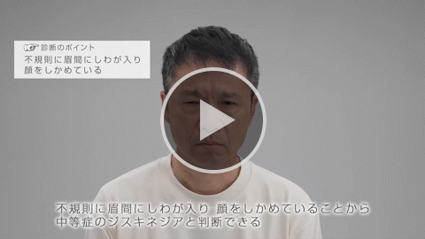 表情筋 中等症 症例2