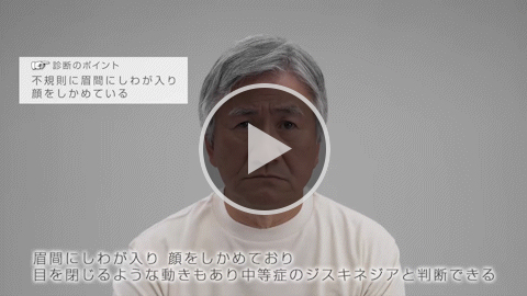 表情筋 中等症 症例3