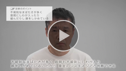 表情筋 重症 症例1