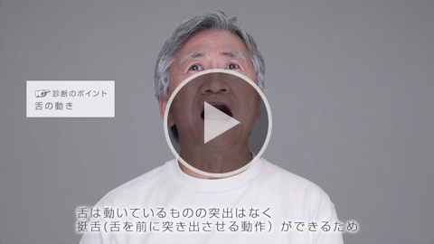 舌 中等症 症例1