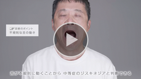 舌 中等症 症例2