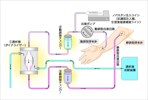 血液透析回路とノバスタン®HI注10mg/2mLの投与方法